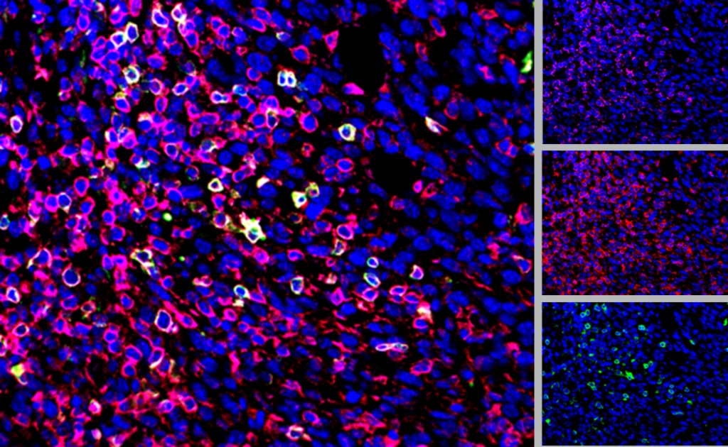 图2:CD3(粉红色),CD4(绿色)、CD45(红色),和DAPI染色(蓝色)在CT26肿瘤。